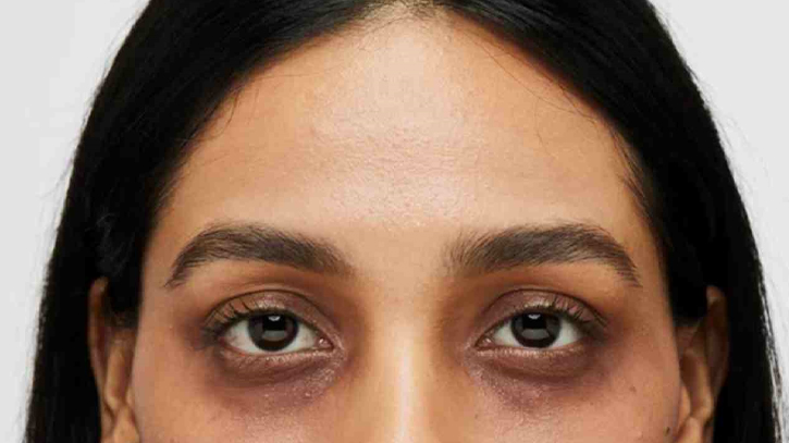 চোখের নিচের কালো দাগ হবে জীবনযাপনে